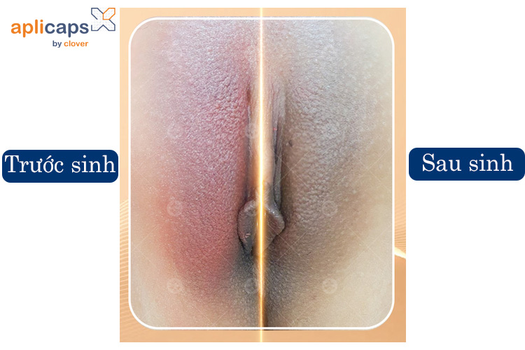 sinh-mo-van-khien-co-be-bi-sam-mau
