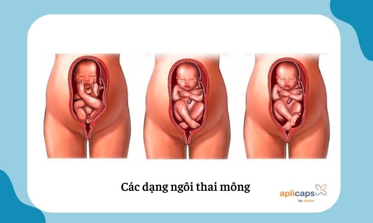 Hình ảnh thai nhi ngôi mông