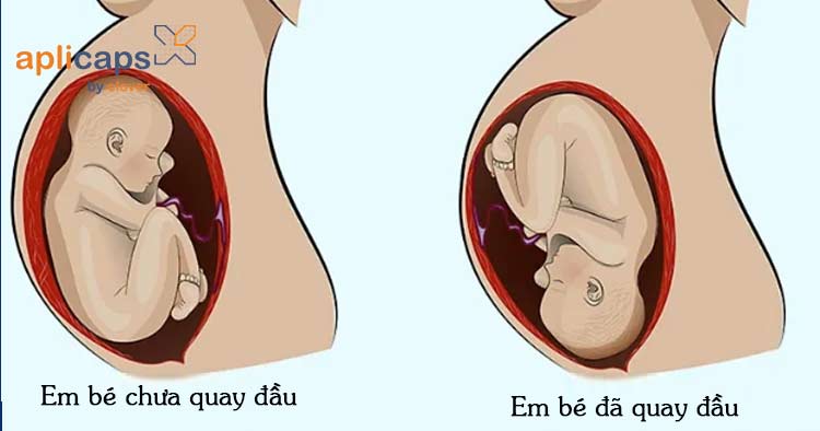 Em bé khi chưa quay đầu và khi đã quay đầu trong bụng mẹ