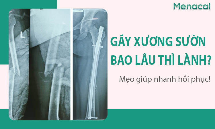 Gãy xương sườn bao lâu thì lành? Mẹo giúp nhanh hồi phục