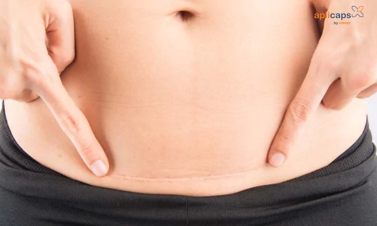Sau 2 năm vết mổ chỉ còn là 1 đường trắng mờ