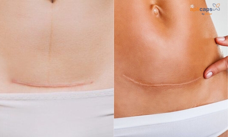 Mổ ngang là phương pháp được sử dụng phổ biến hiện nay