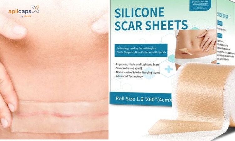 Sử dụng miếng dán silicone để điều trị sẹo lồi