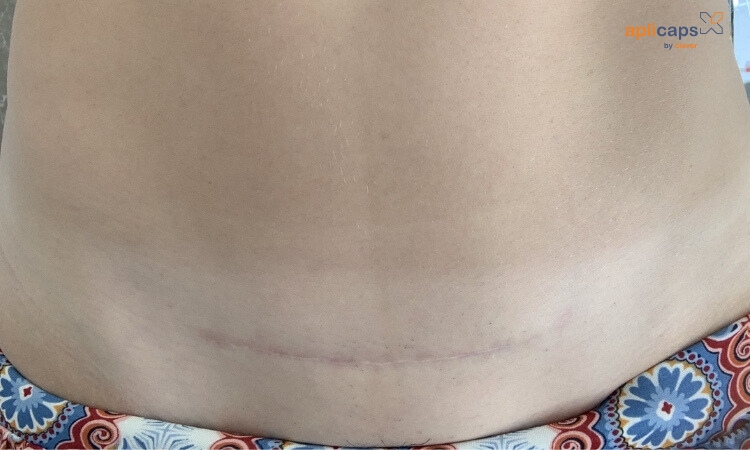 Sau 8 tháng vết mổ gần như đã lành lại hoàn toàn