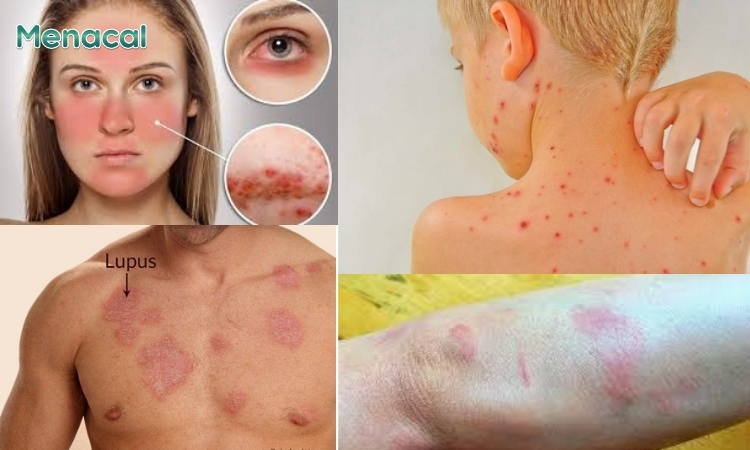 Bệnh Lupus ban đỏ hệ thống