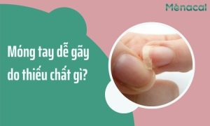 Móng tay dễ gãy do thiếu chất gì