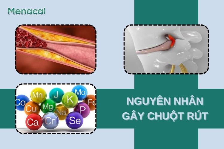 Một số nguyên nhân gây chuột rút