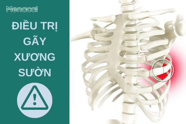 Điều trị gãy xương sườn