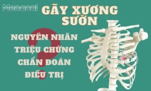 Gãy xương sườn