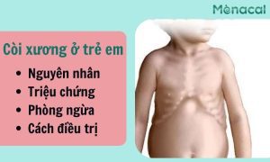 Còi xương ở trẻ em: Nguyên nhân, triệu chứng, phòng ngừa và điều trị toàn diện