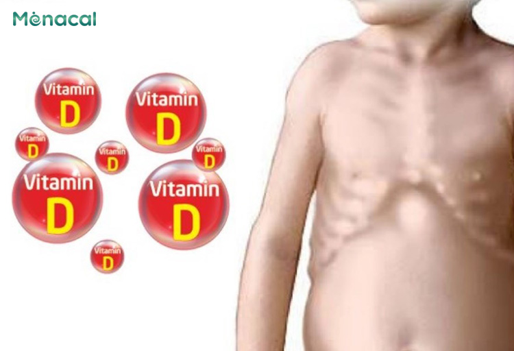 Thiếu hụt vitamin D là nguyên nhân chính gây ra còi xương do dinh dưỡng