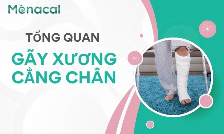 gãy xương cẳng chân