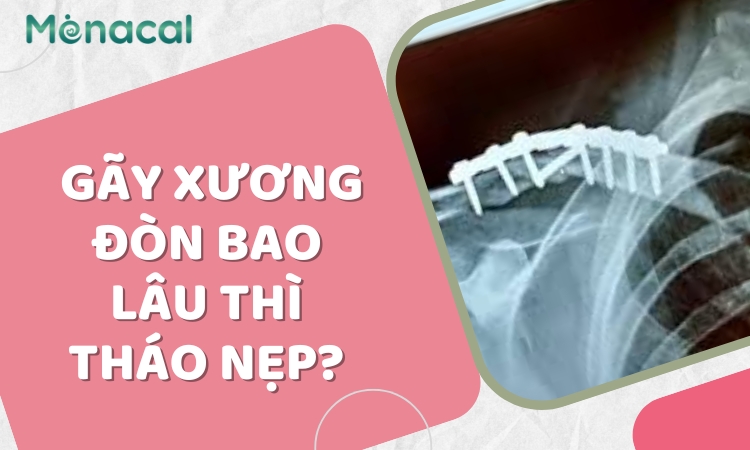 Gãy xương đòn bao lâu thì tháo nẹp