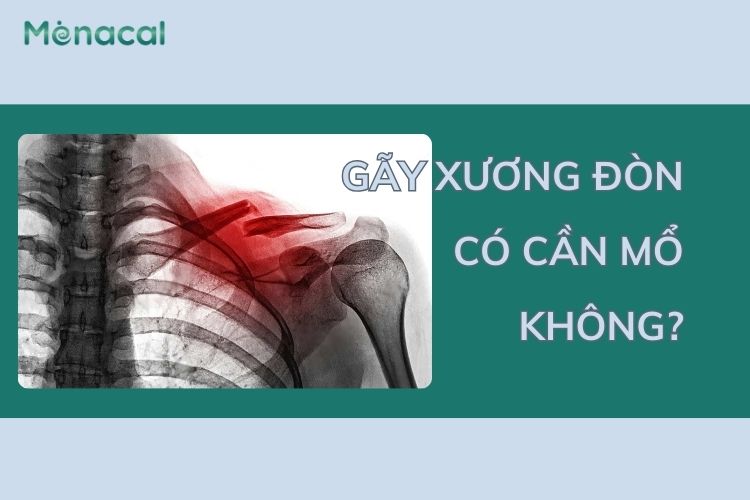 gãy xương đòn có phải mổ không