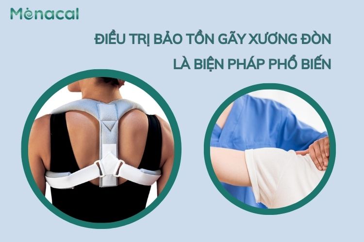 Điều trị bảo tồn ở bệnh nhân bị gãy xương đòn