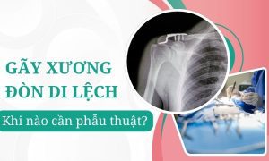 Gãy xương đòn di lệch: Khi nào cần phẫu thuật?