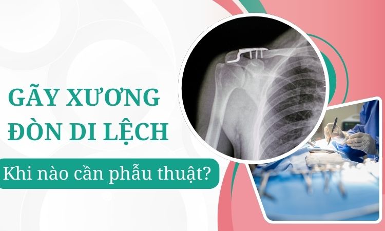 Gãy xương đòn di lệch: Khi nào cần phẫu thuật?