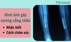 Hình ảnh gãy xương cẳng chân: Nhận biết và cách chăm sóc