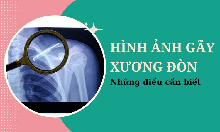 Thực tế hình ảnh gãy xương đòn và những điều cần biết