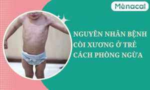 Nguyên nhân bệnh còi xương ở trẻ và cách phòng ngừa