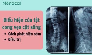 Biểu hiện của tật cong vẹo cột sống