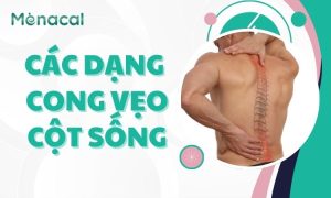 Các dạng cong vẹo cột sống