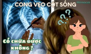 Cong vẹo cột sống có chữa được không?