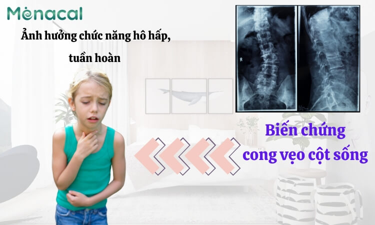 Khó thở - Hậu quả của cong vẹo cột sống