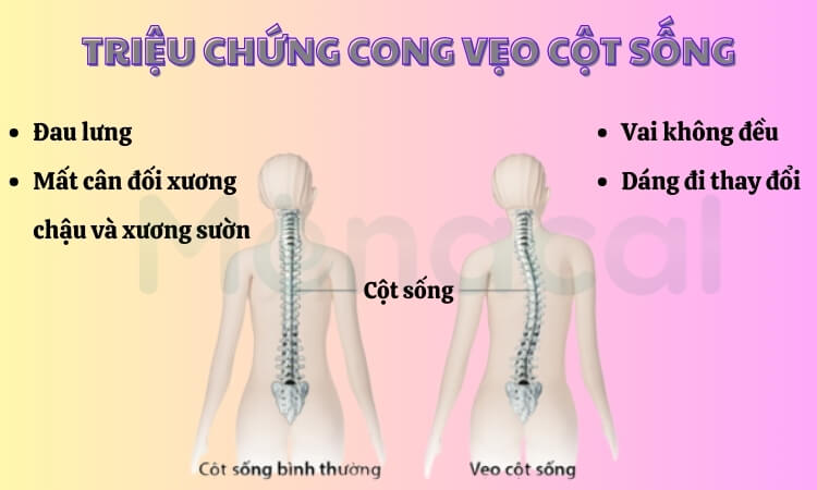 Triệu chứng trẻ bị cong vẹo cột sống