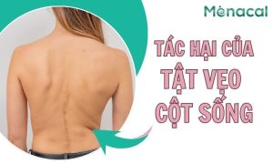 Tác hại của tật cong vẹo cột sống