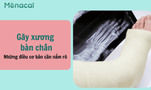 Gãy xương bàn chân