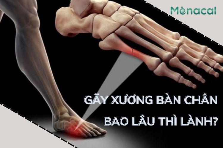 Thời gian lành xương phụ thuộc vào tình trạng mỗi người