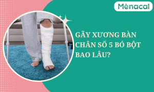 Gãy xương bàn chân số 5 bó bột bao lâu