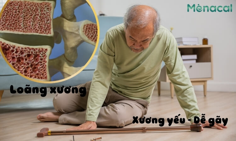 Loãng xương - Một trong những nguyên nhân gây gãy 1/3  dưới xương chày