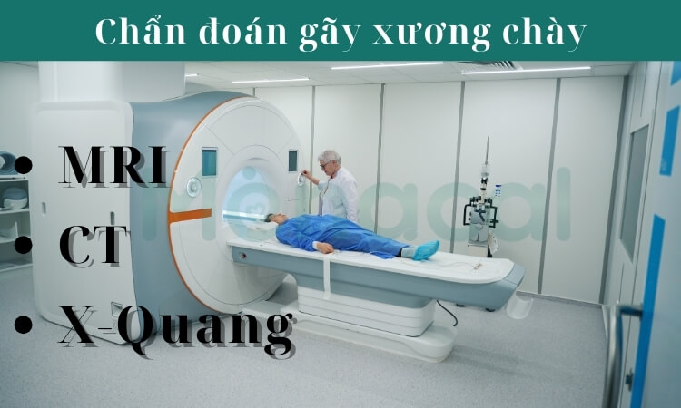 Các phương pháp chẩn đoán gãy 1/3 dưới xương chày