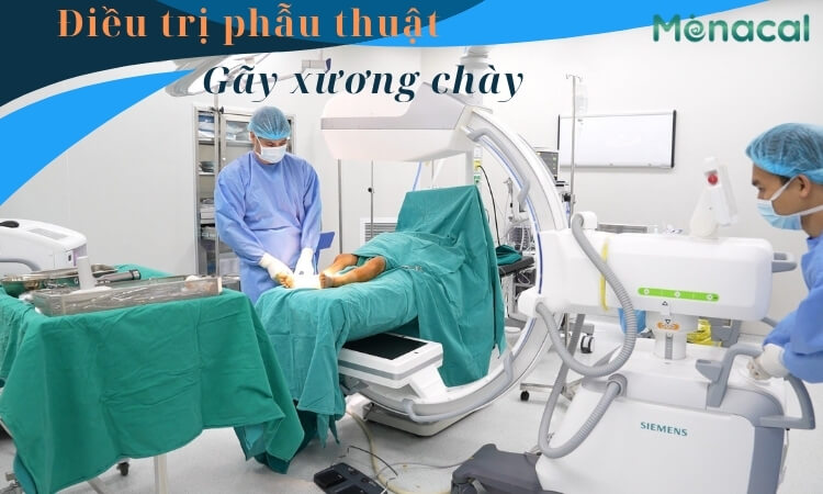 Chỉ định phẫu thuật gãy xương chày