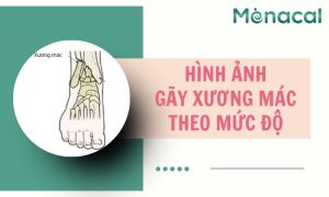 hinh-anh-gay-xuong-mac