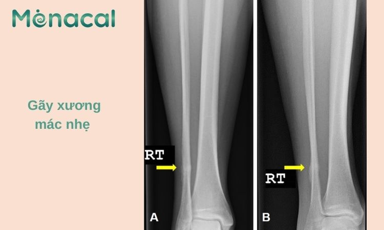 Hình ảnh gãy xương mác nhẹ