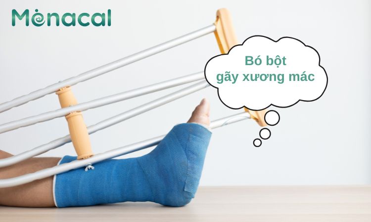 Bó bột là phương pháp điều trị gãy xương mác được áp dụng phổ biến nhất