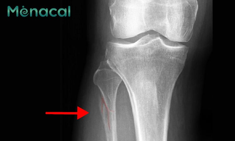 Hình ảnh gãy xương mác di lệch trên phim X - quang