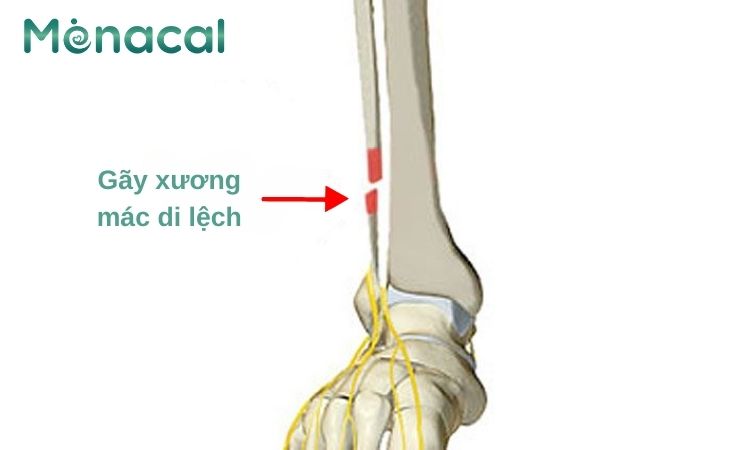 Hình ảnh minh hoạ gãy xương mác di lệch