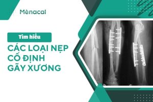 Các loại nẹp cố định gãy xương