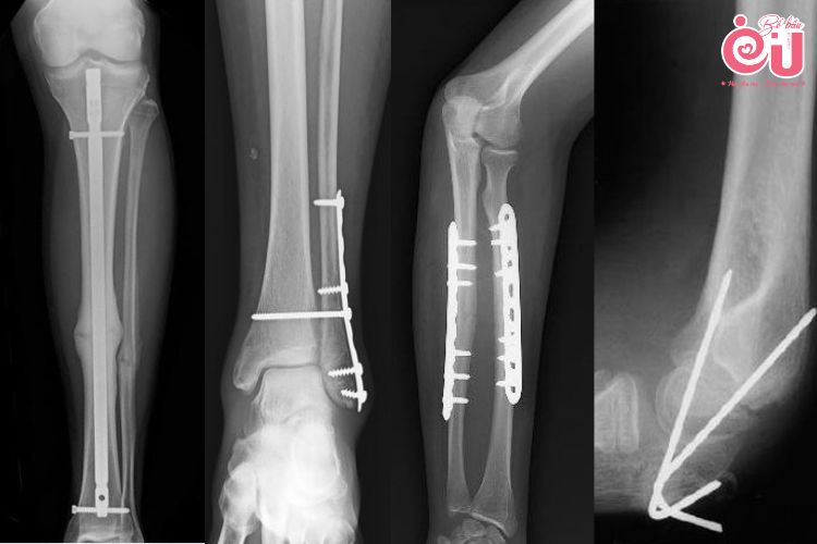 Các loại nẹp cố định xương phổ biến