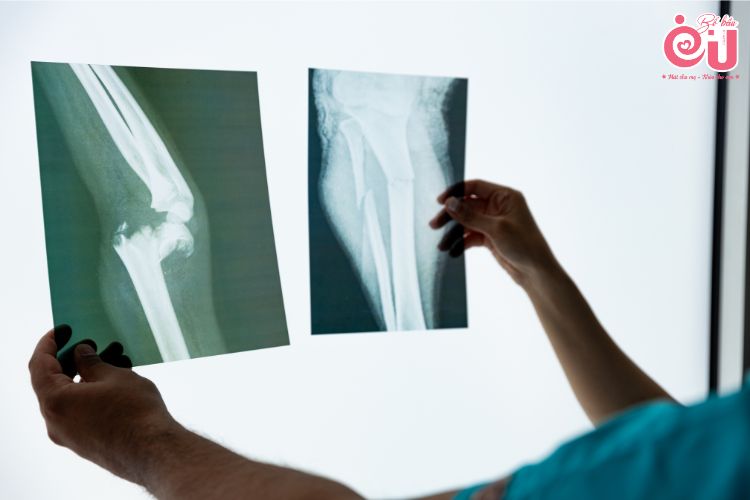Bệnh nhân sau khi nẹp cố định gãy xương cần thăm khám định kỳ