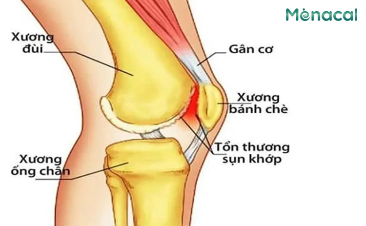 Xương bánh chè là xương nằm trong gân và giữ vai trò bảo vệ khớp gối