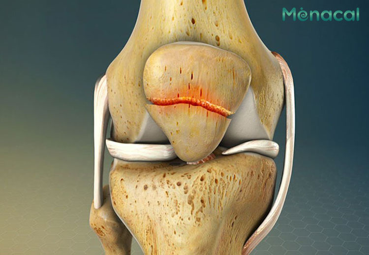 Gãy xương bánh chè có thể do va đập mạnh vào đầu gối gây ra