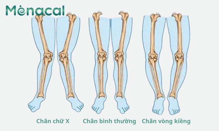 Chân chữ X và chân vòng kiềng là khác nhau