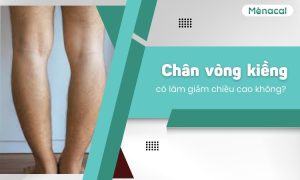 Chân vòng kiềng có làm giảm chiều cao