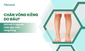 chân vòng kiềng do đâu