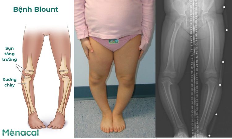 Bệnh Blount (rối loạn phát triển sụn tăng trưởng)